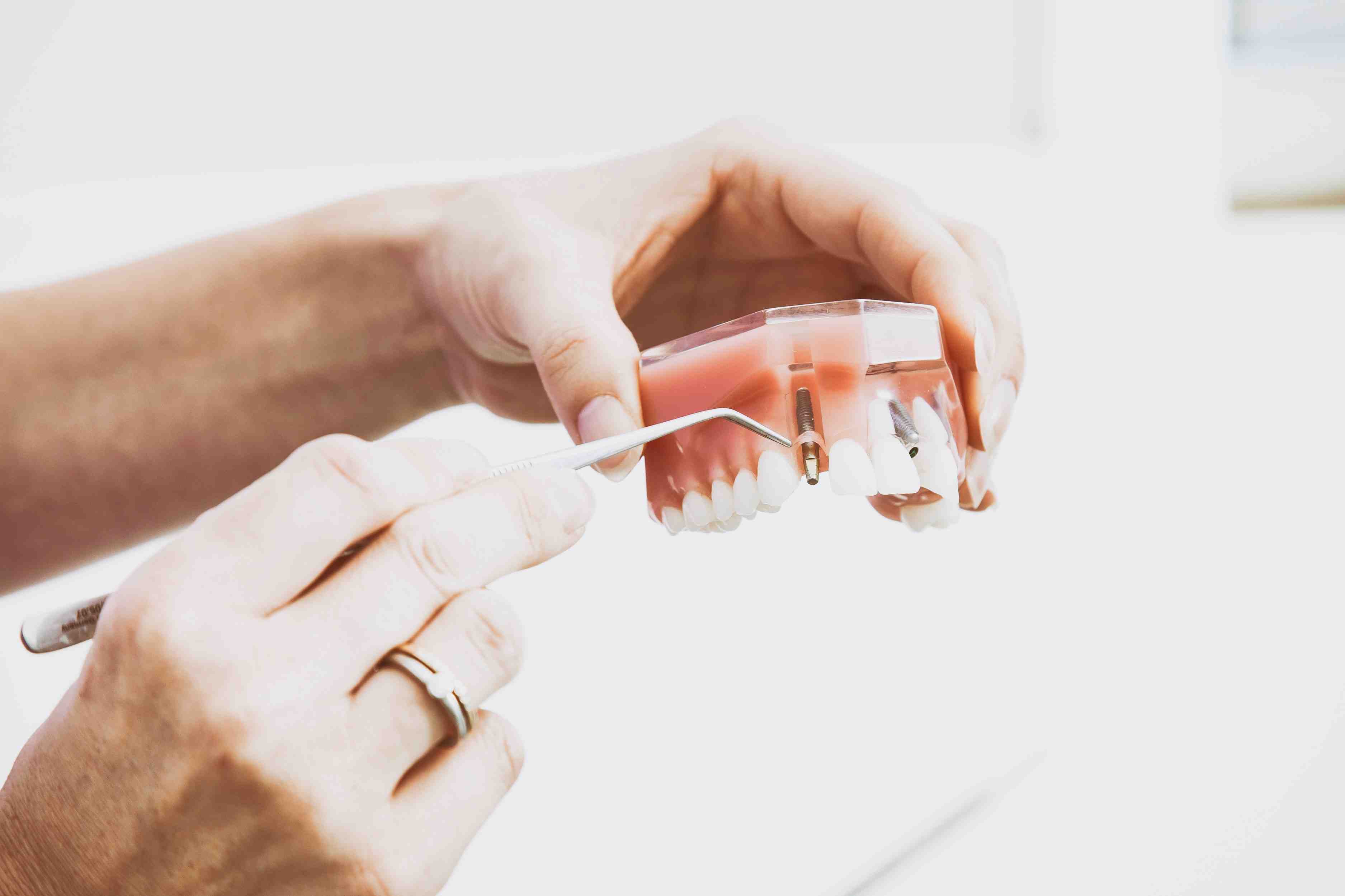 Odbacivanje zubnog implanta:Zašto se to dešava i šta onda? 
